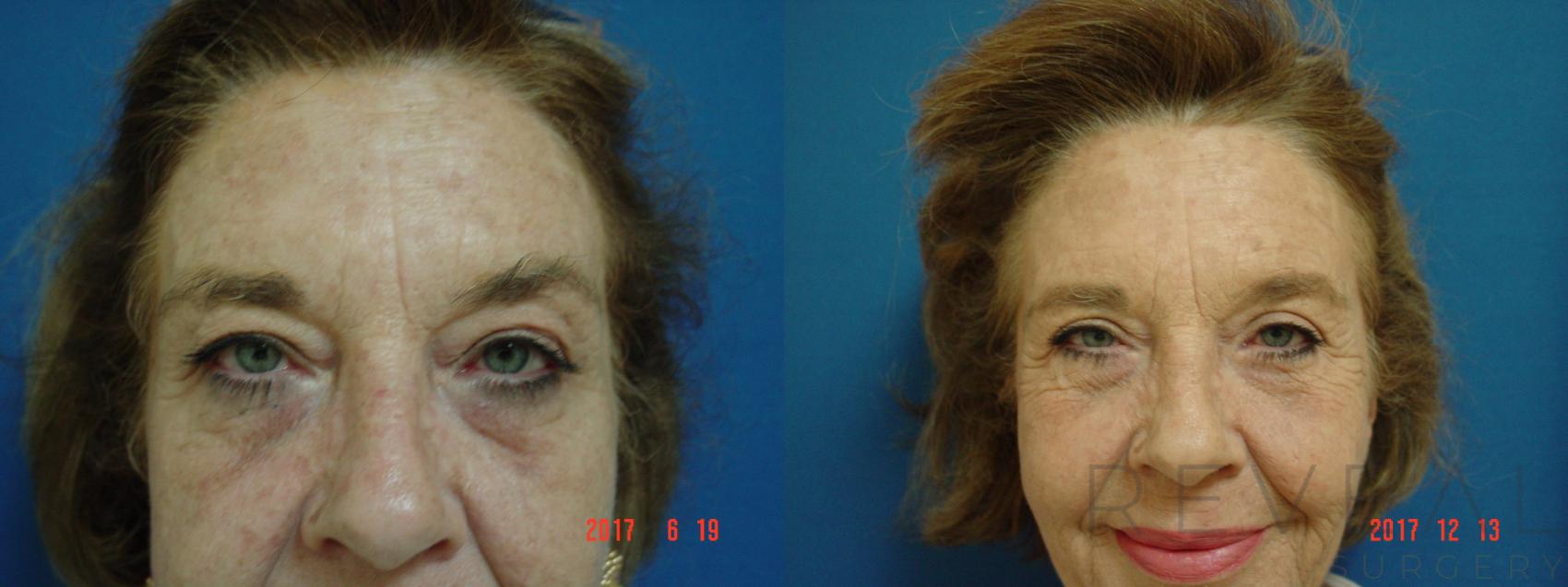 Before & After Eyelid Surgery Case 236 View #2 View in San Jose, CA