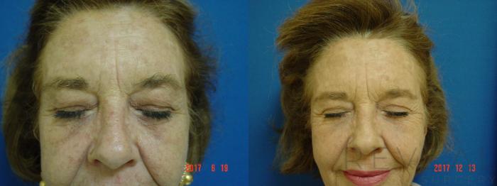 Before & After Eyelid Surgery Case 236 View #3 View in San Jose, CA