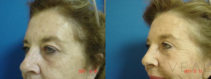 Before & After Eyelid Surgery Case 236 View #4 View in San Jose, CA
