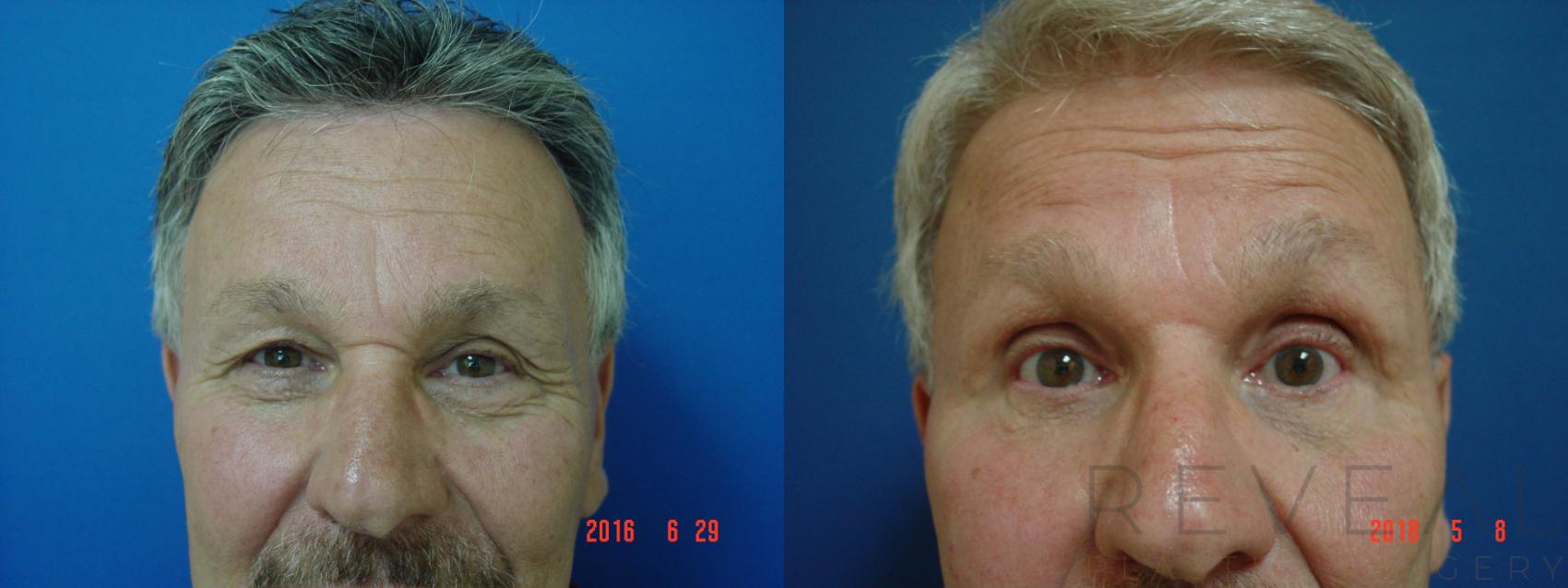 Before & After Eyelid Surgery Case 239 View #1 View in San Jose, CA