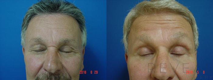 Before & After Eyelid Surgery Case 239 View #2 View in San Jose, CA