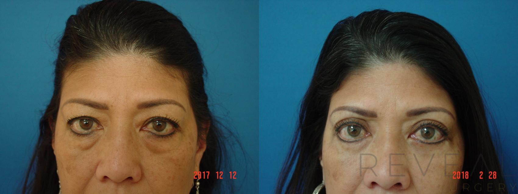 Before & After Eyelid Surgery Case 241 View #1 View in San Jose, CA