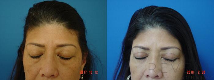 Before & After Eyelid Surgery Case 241 View #2 View in San Jose, CA