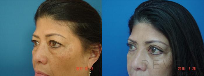 Before & After Eyelid Surgery Case 241 View #3 View in San Jose, CA
