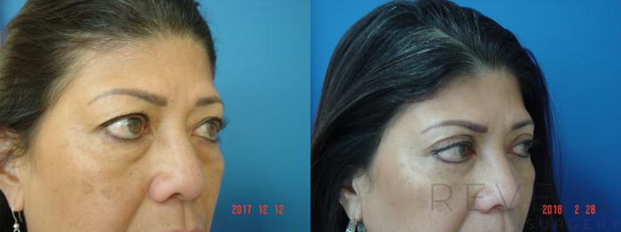 Before & After Eyelid Surgery Case 241 View #4 View in San Jose, CA