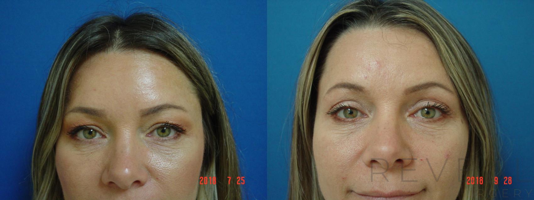Before & After Eyelid Surgery Case 258 View #1 View in San Jose, CA