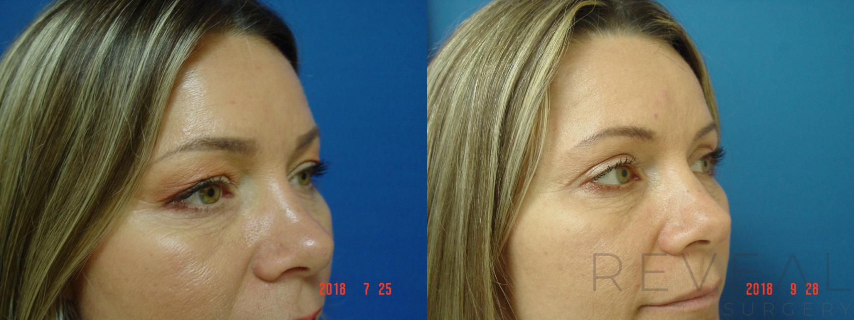 Before & After Eyelid Surgery Case 258 View #2 View in San Jose, CA