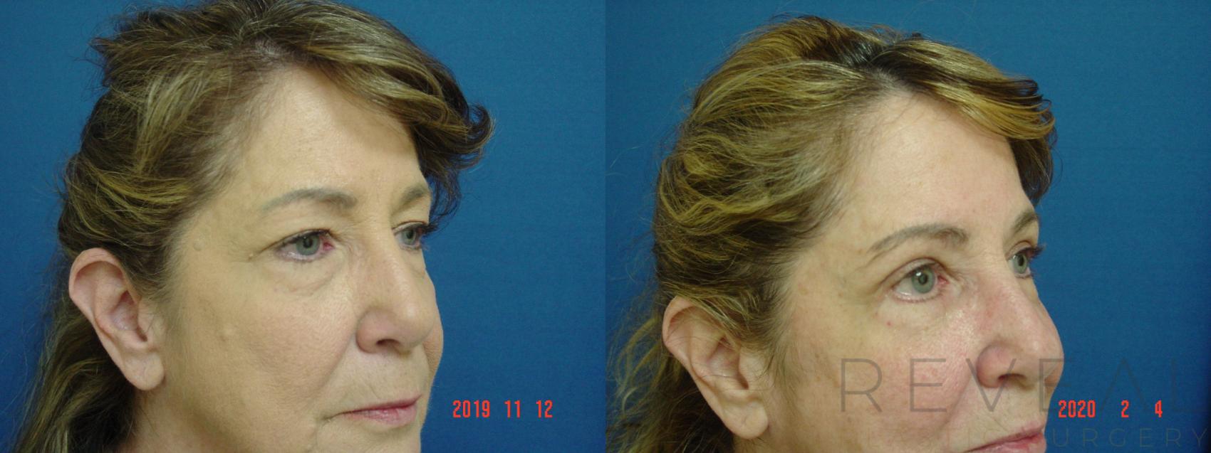 Before & After Eyelid Surgery Case 392 View #2 View in San Jose, CA