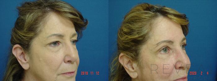 Before & After Eyelid Surgery Case 392 View #2 View in San Jose, CA