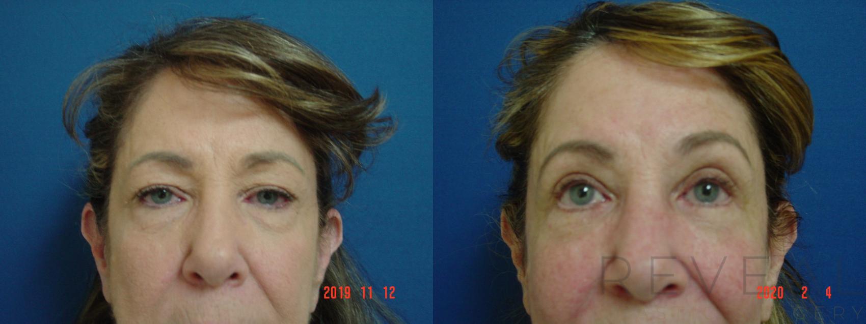 Before & After Eyelid Surgery Case 392 View #3 View in San Jose, CA
