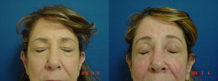 Before & After Eyelid Surgery Case 392 View #4 View in San Jose, CA