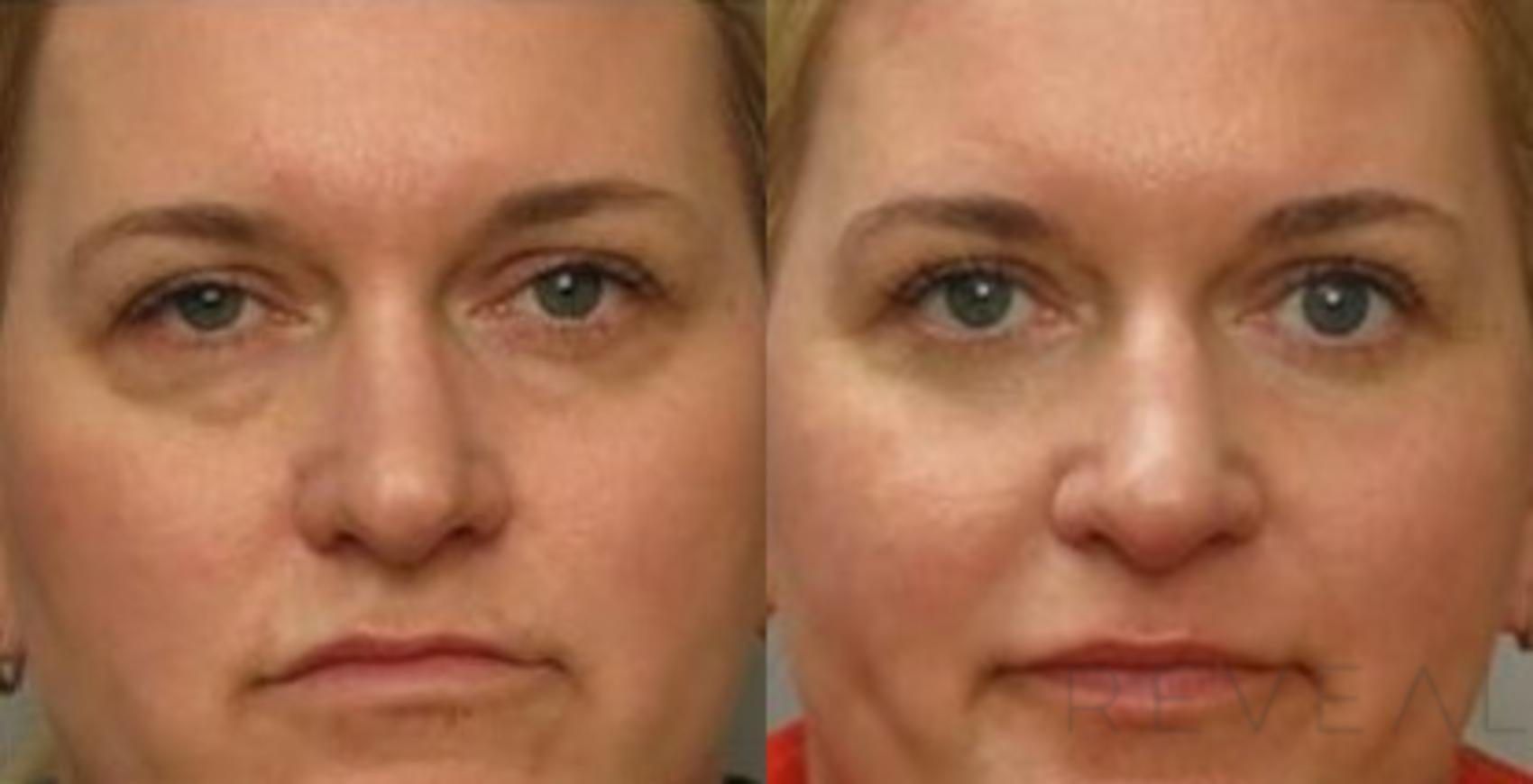 Before & After Eyelid Surgery Case 410 View #1 View in San Jose, CA
