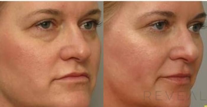 Before & After Eyelid Surgery Case 410 View #2 View in San Jose, CA