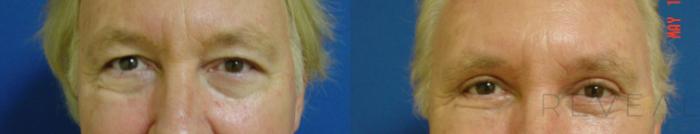 Before & After Eyelid Surgery Case 43 View #1 View in San Jose, CA