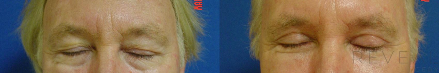 Before & After Eyelid Surgery Case 43 View #2 View in San Jose, CA