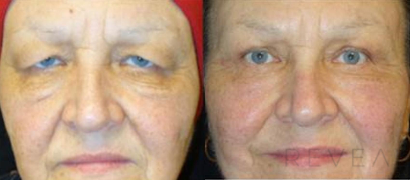 Before & After Facelift Case 462 View #1 View in San Jose, CA