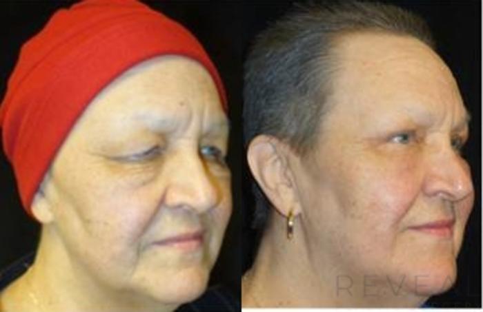 Before & After Eyelid Surgery Case 462 View #2 View in San Jose, CA