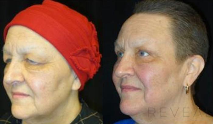 Before & After Eyelid Surgery Case 462 View #3 View in San Jose, CA