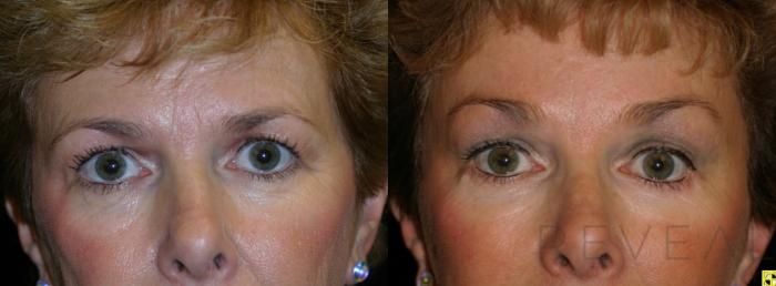 Before & After Eyelid Surgery Case 469 View #1 View in San Jose, CA