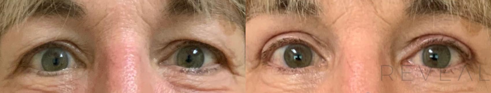 Before & After Eyelid Surgery Case 472 View #1 View in San Jose, CA