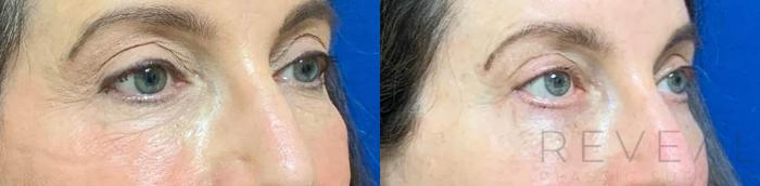 Before & After Eyelid Surgery Case 477 View #2 View in San Jose, CA