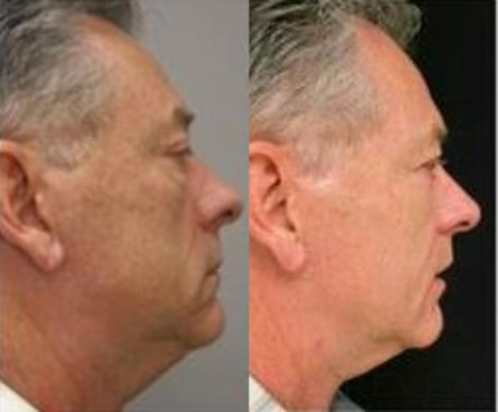 Before & After Eyelid Surgery Case 482 View #2 View in San Jose, CA