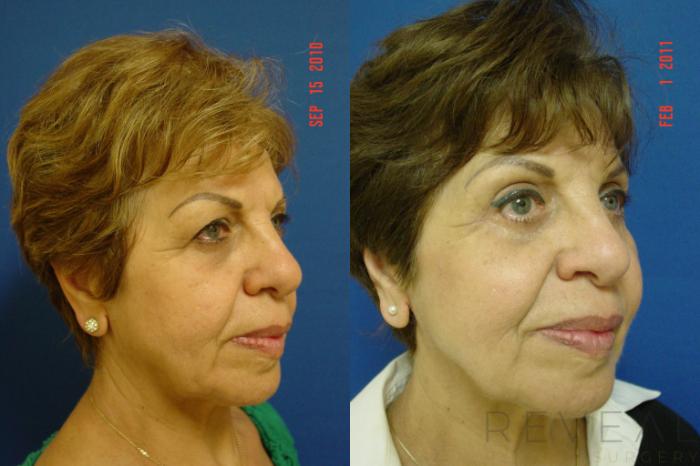 Before & After Eyelid Surgery Case 50 View #1 View in San Jose, CA