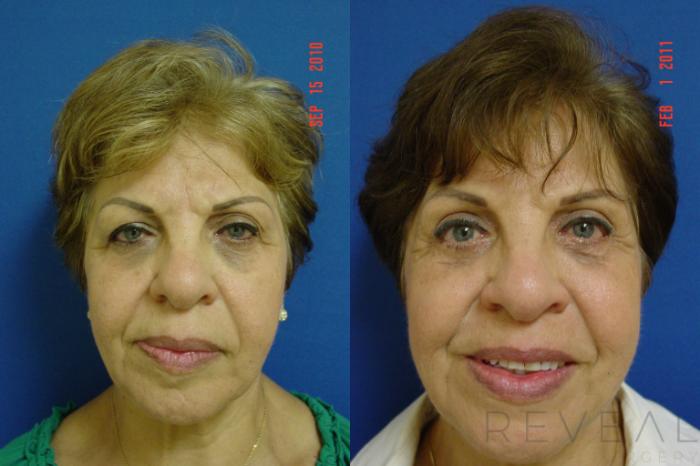 Before & After Eyelid Surgery Case 50 View #2 View in San Jose, CA