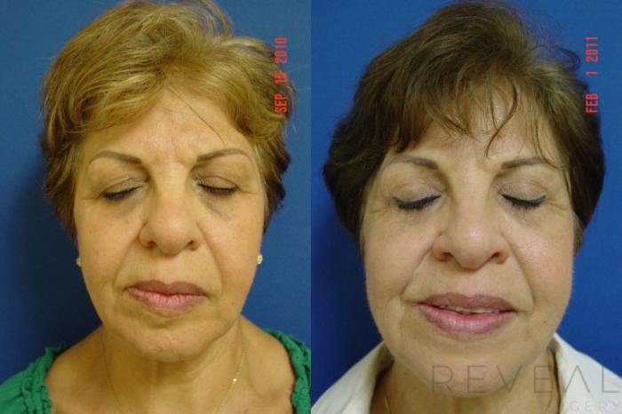 Before & After Eyelid Surgery Case 50 View #3 View in San Jose, CA