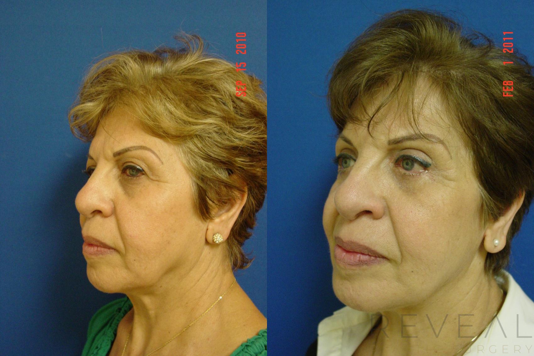 Before & After Eyelid Surgery Case 50 View #4 View in San Jose, CA
