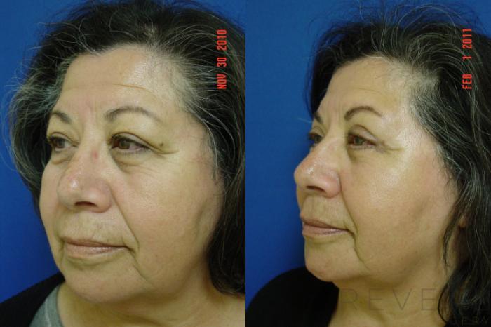 Before & After Eyelid Surgery Case 51 View #1 View in San Jose, CA