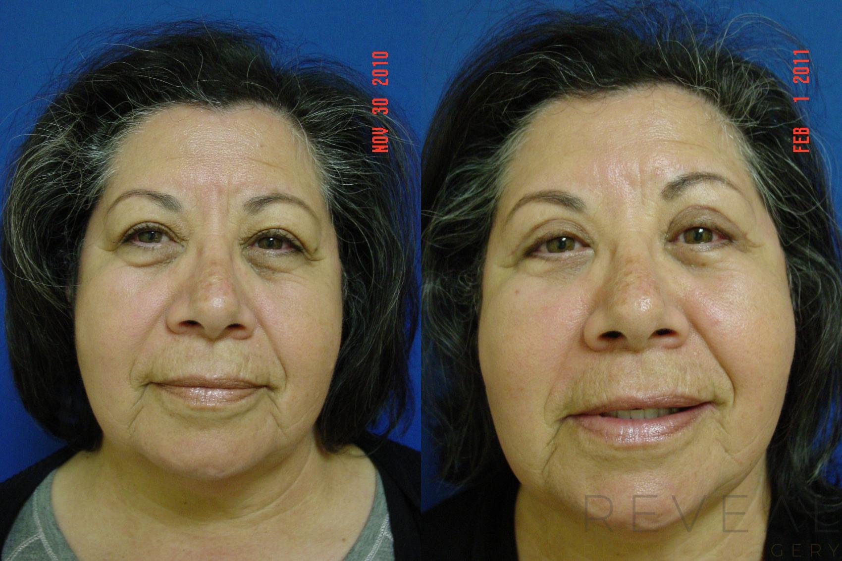 Before & After Eyelid Surgery Case 51 View #2 View in San Jose, CA