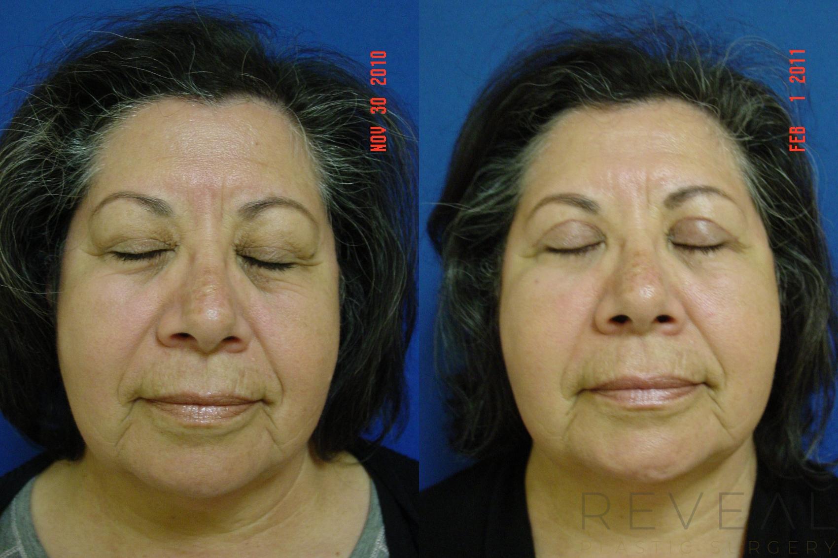 Before & After Eyelid Surgery Case 51 View #3 View in San Jose, CA