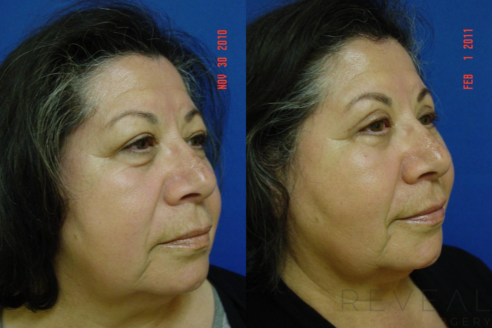 Before & After Eyelid Surgery Case 51 View #4 View in San Jose, CA