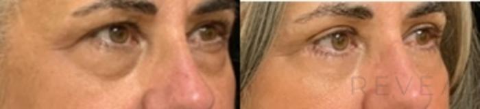 Before & After Eyelid Surgery Case 536 View #1 View in San Jose, CA