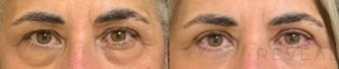 Before & After Eyelid Surgery Case 536 View #2 View in San Jose, CA