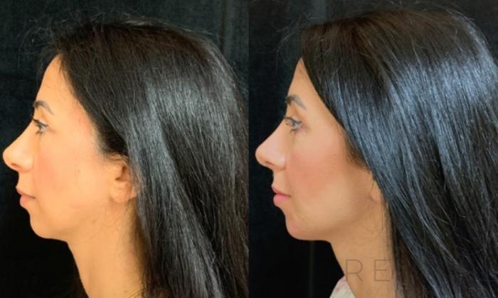 Before & After Injectable Fillers Case 578 View #2 View in San Jose, CA