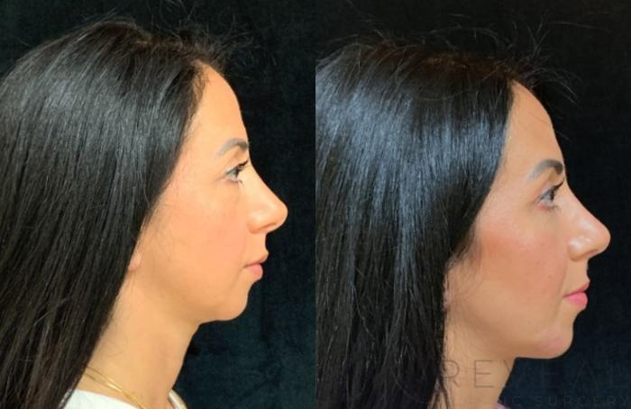 Before & After Chin Augmentation Case 578 View #3 View in San Jose, CA