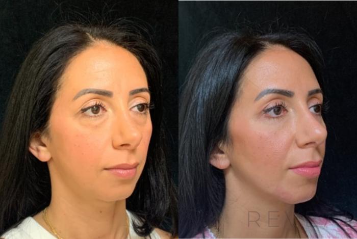Before & After Chin Augmentation Case 578 View #4 View in San Jose, CA