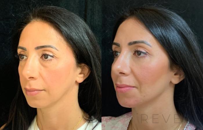 Before & After Injectable Fillers Case 578 View #5 View in San Jose, CA