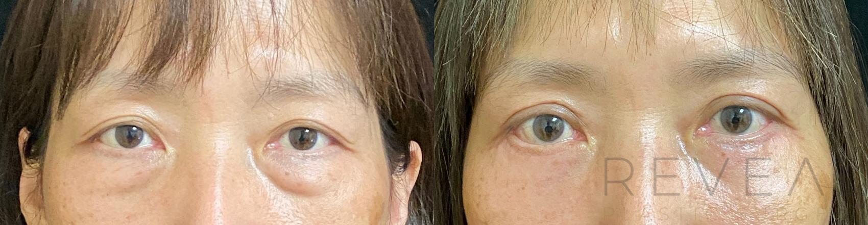 Before & After Eyelid Surgery Case 579 View #1 View in San Jose, CA