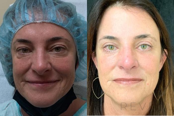 Before & After Eyelid Surgery Case 593 Front View in San Jose, CA