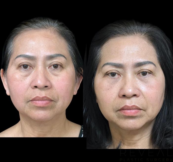 Before & After Eyelid Surgery Case 647 Front View in San Jose, CA