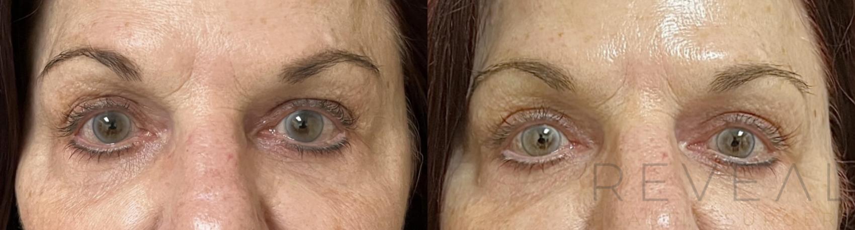 Before & After Eyelid Surgery Case 658 Front View in San Jose, CA