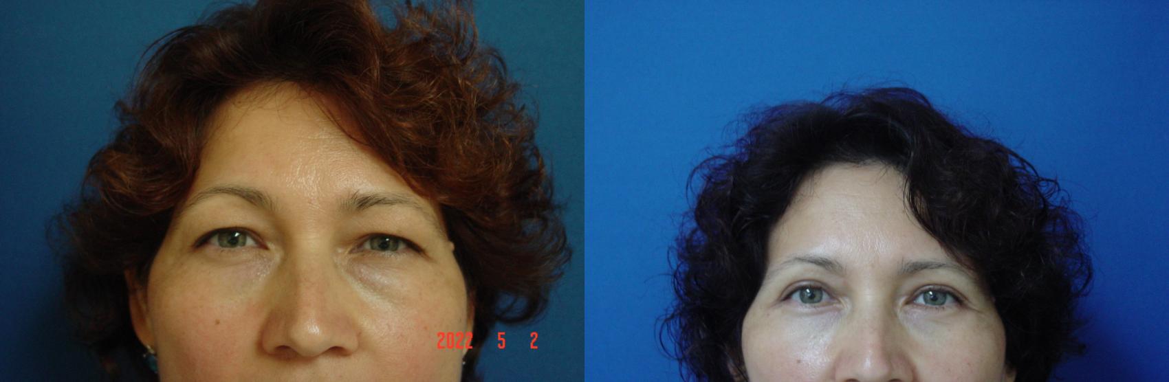 Before & After Eyelid Surgery Case 661 Front View in San Jose, CA