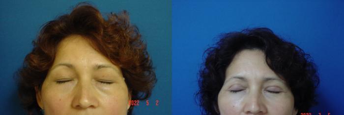 Before & After Eyelid Surgery Case 661 Front eyes closed View in San Jose, CA