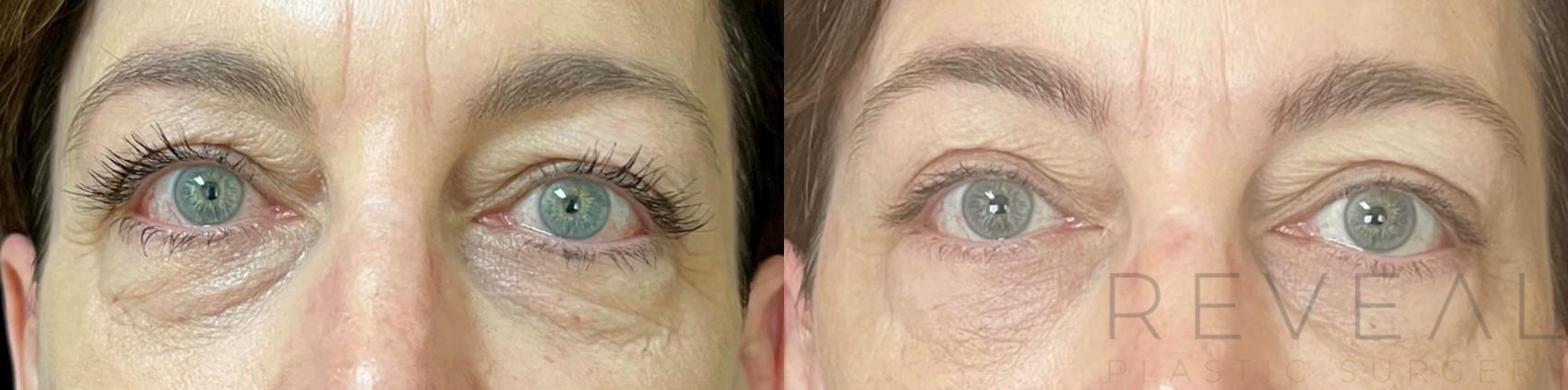 Before & After Eyelid Surgery Case 668 Front View in San Jose, CA