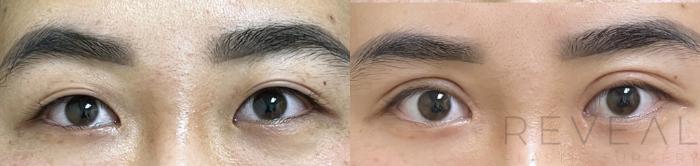 Before & After Eyelid Surgery Case 672 Front View in San Jose, CA