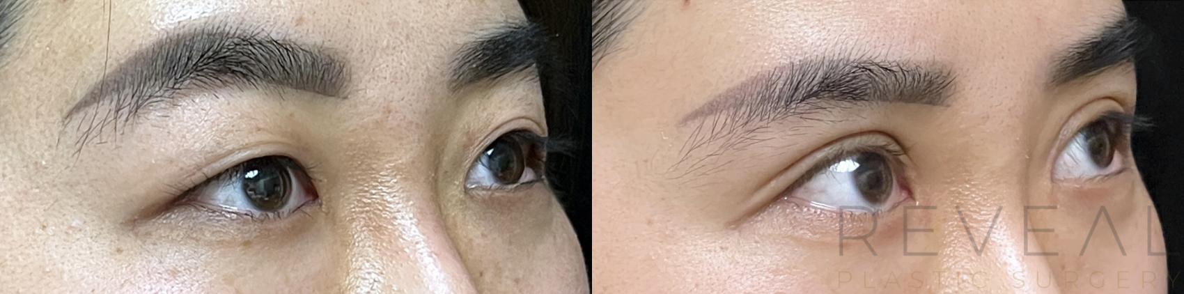 Before & After Eyelid Surgery Case 672 Left Side View in San Jose, CA