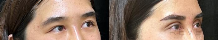 Before & After Eyelid Surgery Case 677 Left Side View in San Jose, CA